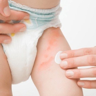 Diaper Rash Care